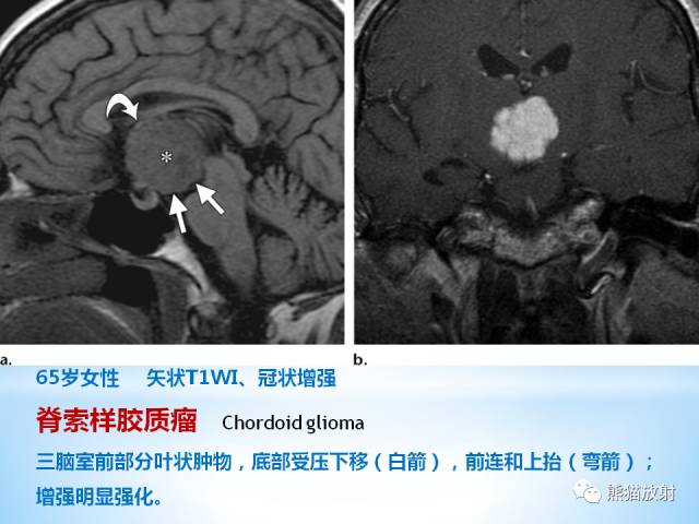 【PPT】三脑室病变的MRI表现