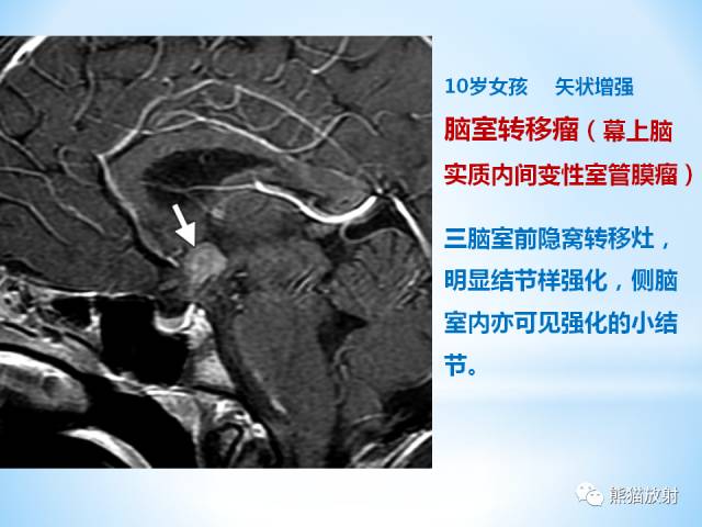 【PPT】三脑室病变的MRI表现