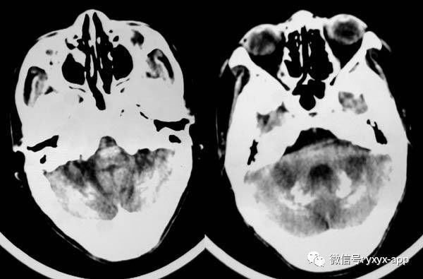 【病例】甲状旁腺功能减退1例CT影像表现