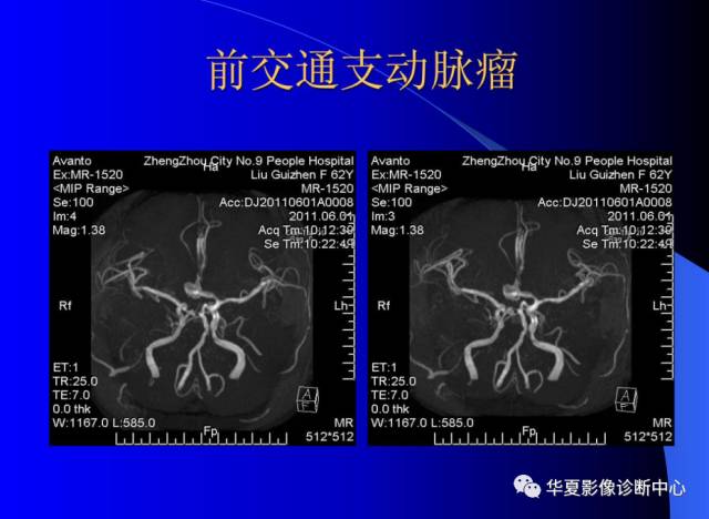 【PPT】颅脑MRA的应用体会与分析