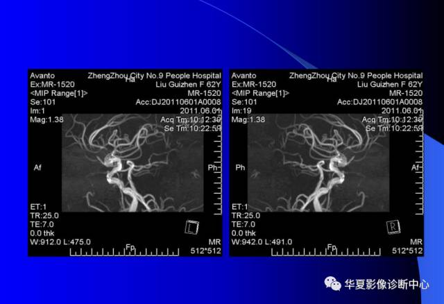 【PPT】颅脑MRA的应用体会与分析