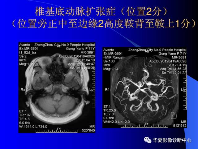 【PPT】颅脑MRA的应用体会与分析