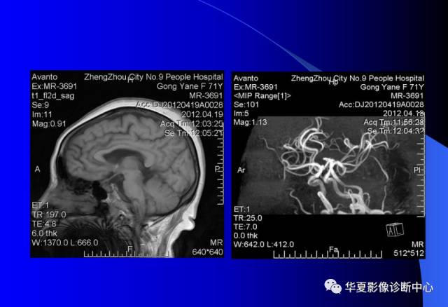 【PPT】颅脑MRA的应用体会与分析