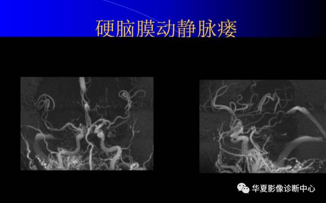 【PPT】颅脑MRA的应用体会与分析