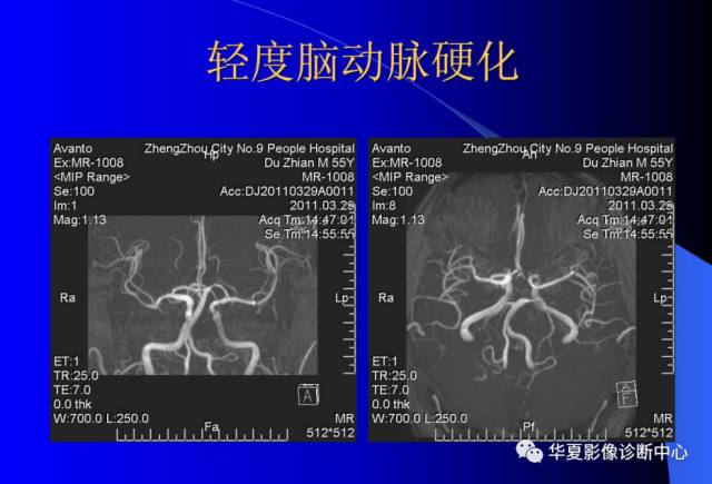 【PPT】颅脑MRA的应用体会与分析