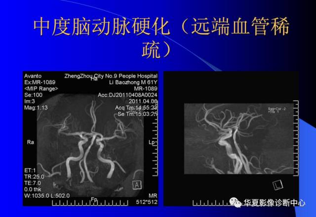 【PPT】颅脑MRA的应用体会与分析