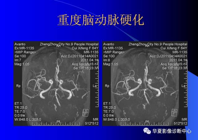 【PPT】颅脑MRA的应用体会与分析