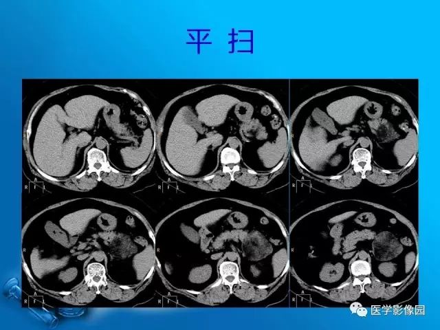 【病例】肾上腺髓样脂肪瘤髓样脂肪瘤1例CT影像表现 【病例】肾上腺髓样脂肪瘤髓样脂肪瘤1例CT影像表现