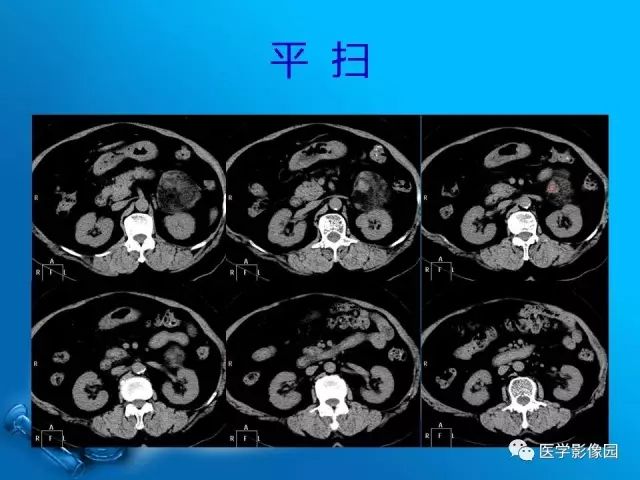 【病例】肾上腺髓样脂肪瘤髓样脂肪瘤1例CT影像表现 【病例】肾上腺髓样脂肪瘤髓样脂肪瘤1例CT影像表现