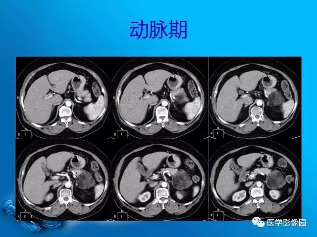 【病例】肾上腺髓样脂肪瘤髓样脂肪瘤1例CT影像表现 【病例】肾上腺髓样脂肪瘤髓样脂肪瘤1例CT影像表现