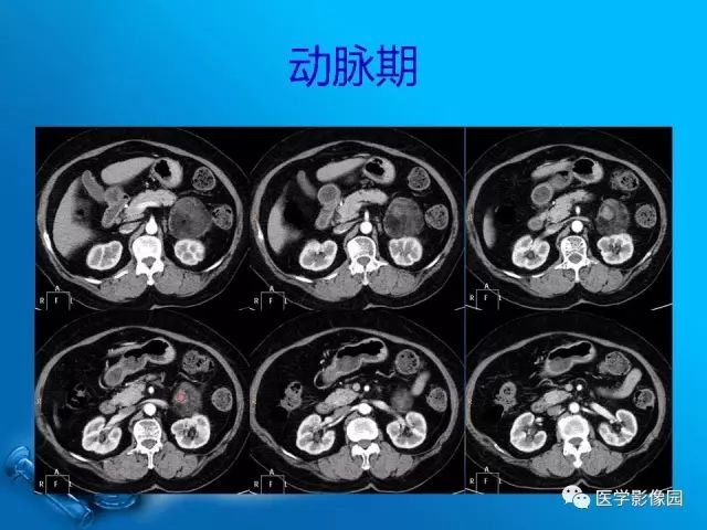 【病例】肾上腺髓样脂肪瘤髓样脂肪瘤1例CT影像表现 【病例】肾上腺髓样脂肪瘤髓样脂肪瘤1例CT影像表现