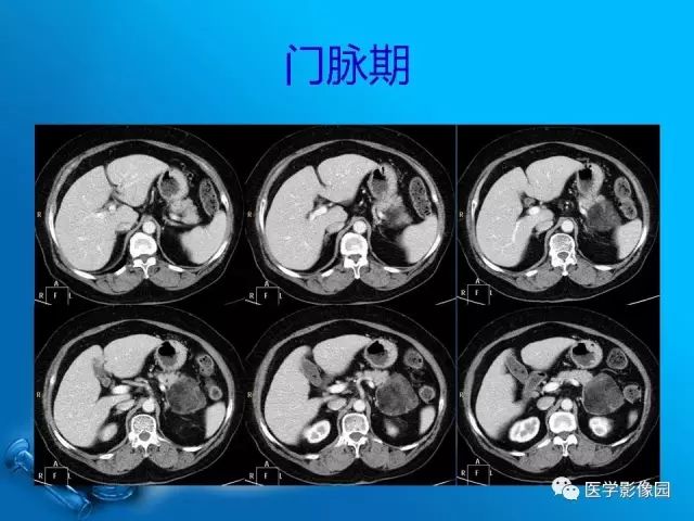 【病例】肾上腺髓样脂肪瘤髓样脂肪瘤1例CT影像表现 【病例】肾上腺髓样脂肪瘤髓样脂肪瘤1例CT影像表现
