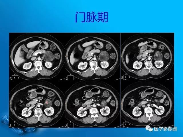 【病例】肾上腺髓样脂肪瘤髓样脂肪瘤1例CT影像表现 【病例】肾上腺髓样脂肪瘤髓样脂肪瘤1例CT影像表现