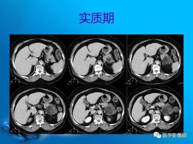 【病例】肾上腺髓样脂肪瘤髓样脂肪瘤1例CT影像表现 【病例】肾上腺髓样脂肪瘤髓样脂肪瘤1例CT影像表现