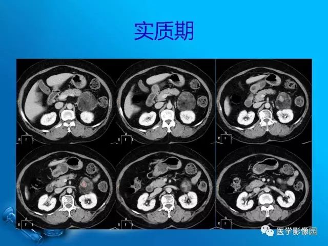 【病例】肾上腺髓样脂肪瘤髓样脂肪瘤1例CT影像表现 【病例】肾上腺髓样脂肪瘤髓样脂肪瘤1例CT影像表现