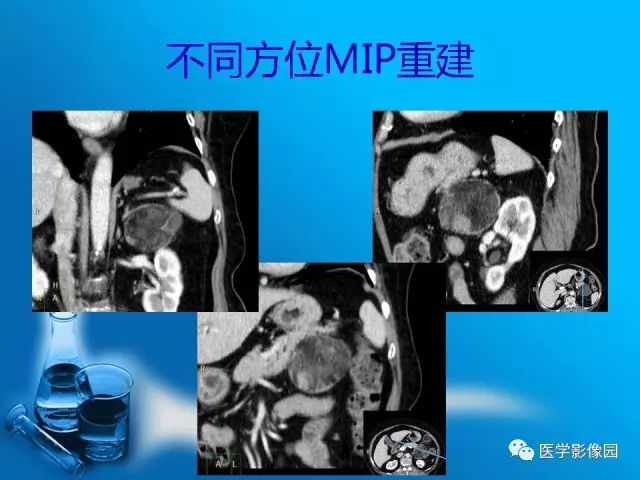 【病例】肾上腺髓样脂肪瘤髓样脂肪瘤1例CT影像表现 【病例】肾上腺髓样脂肪瘤髓样脂肪瘤1例CT影像表现