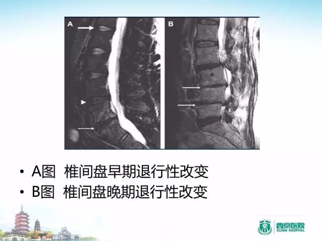 【PPT】容易忽视的腰椎退变MR表现