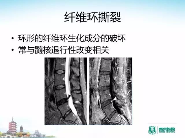 【PPT】容易忽视的腰椎退变MR表现