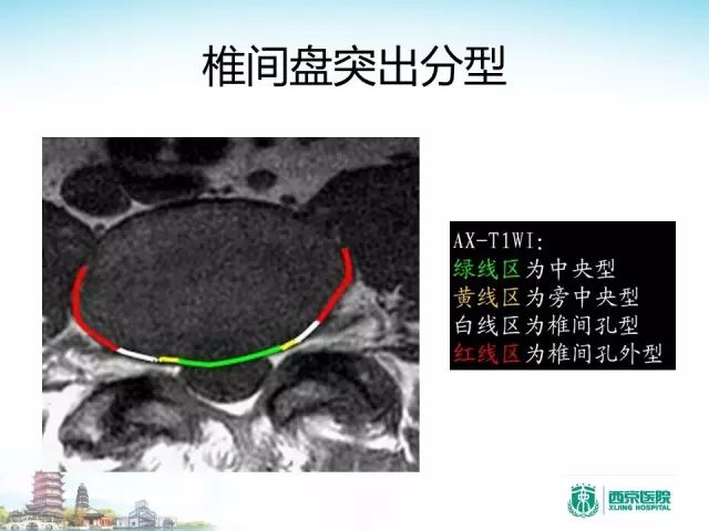 【PPT】容易忽视的腰椎退变MR表现