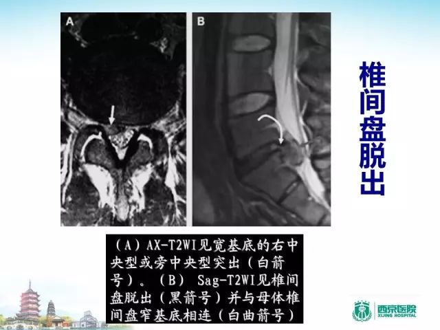 【PPT】容易忽视的腰椎退变MR表现