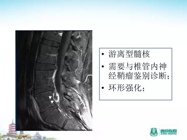 【PPT】容易忽视的腰椎退变MR表现
