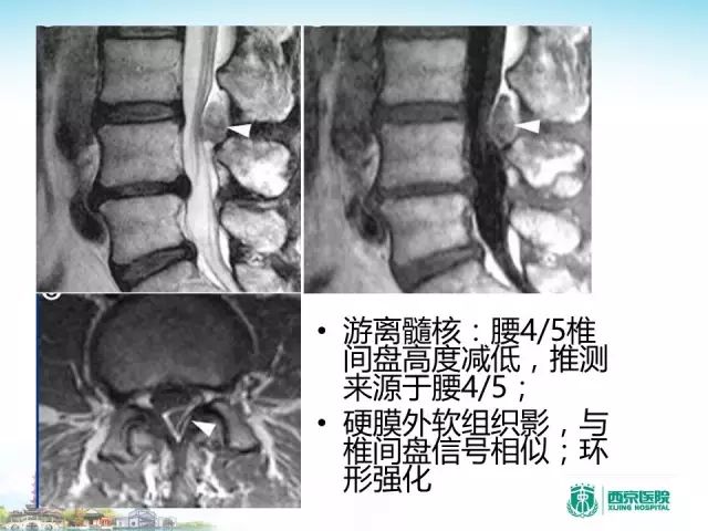 【PPT】容易忽视的腰椎退变MR表现