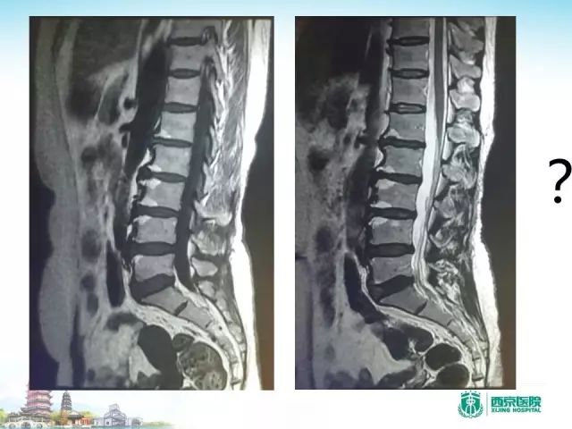 【PPT】容易忽视的腰椎退变MR表现