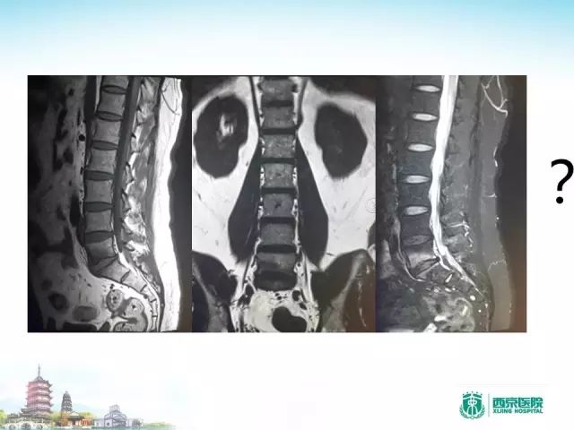 【PPT】容易忽视的腰椎退变MR表现