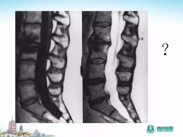 【PPT】容易忽视的腰椎退变MR表现