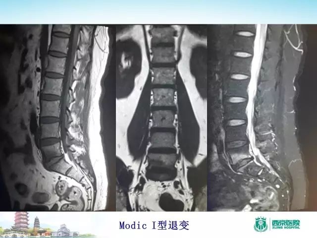 【PPT】容易忽视的腰椎退变MR表现