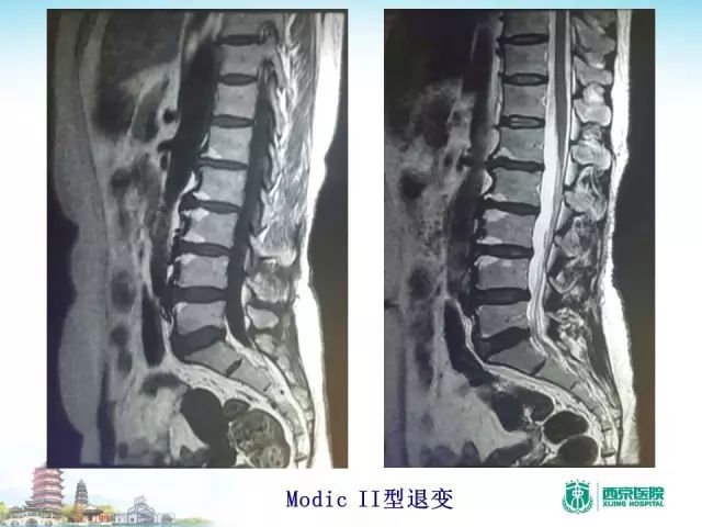 【PPT】容易忽视的腰椎退变MR表现