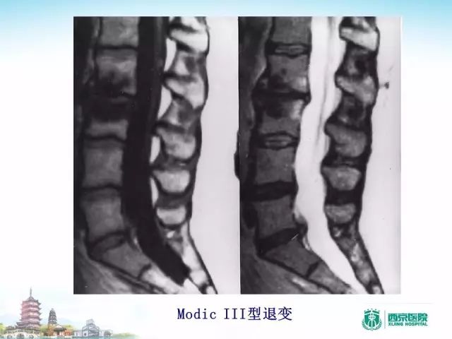 【PPT】容易忽视的腰椎退变MR表现