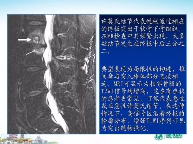 【PPT】容易忽视的腰椎退变MR表现