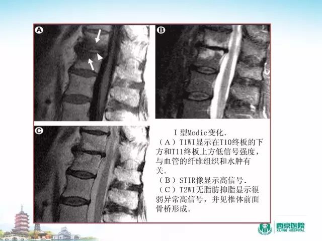 【PPT】容易忽视的腰椎退变MR表现