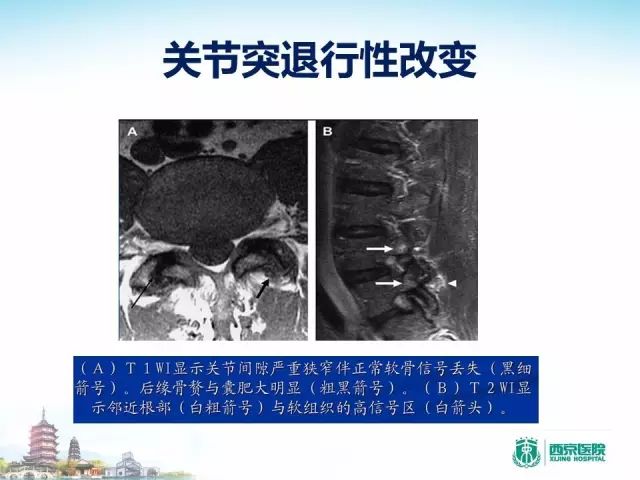 【PPT】容易忽视的腰椎退变MR表现