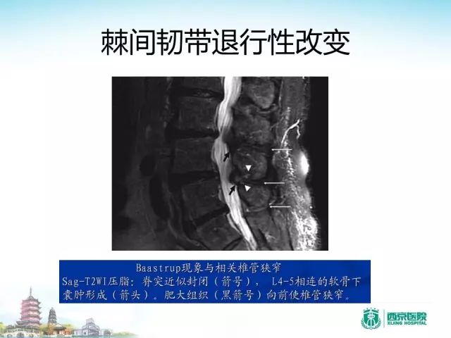 【PPT】容易忽视的腰椎退变MR表现