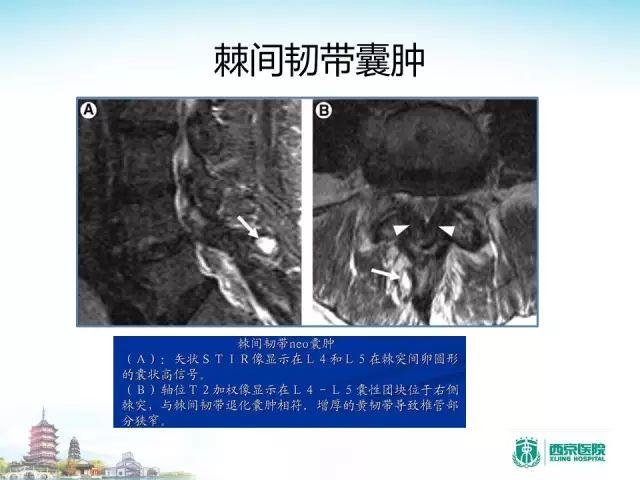 【PPT】容易忽视的腰椎退变MR表现