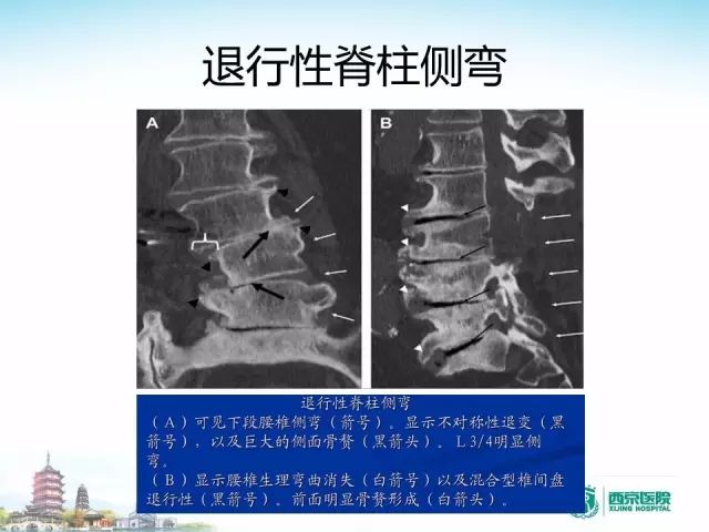 【PPT】容易忽视的腰椎退变MR表现