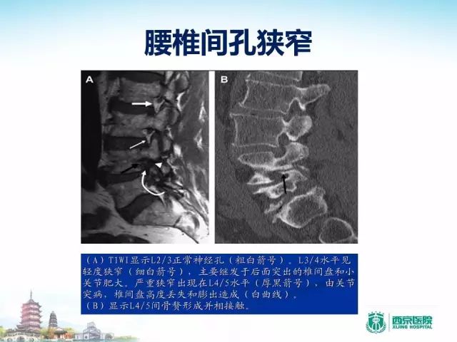 【PPT】容易忽视的腰椎退变MR表现
