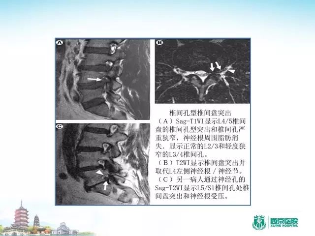 【PPT】容易忽视的腰椎退变MR表现