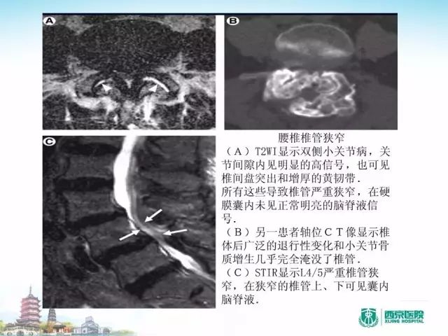 【PPT】容易忽视的腰椎退变MR表现