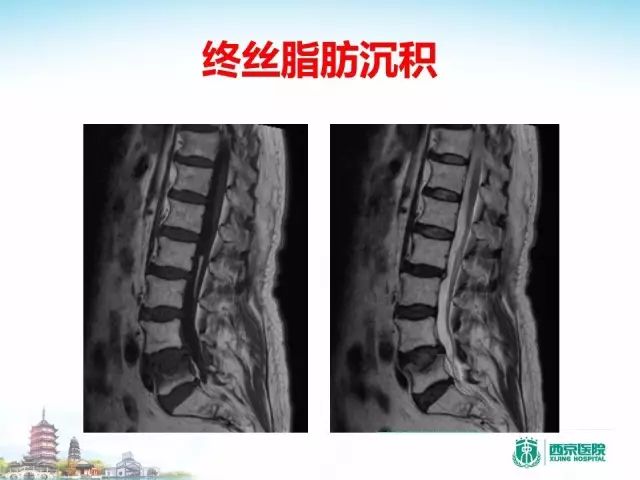 【PPT】容易忽视的腰椎退变MR表现