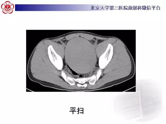 【病例】盆腔副脾蒂扭转1例CT