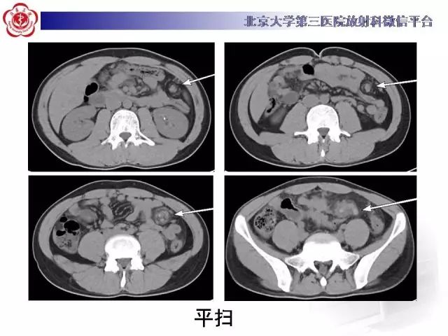 【病例】盆腔副脾蒂扭转1例CT