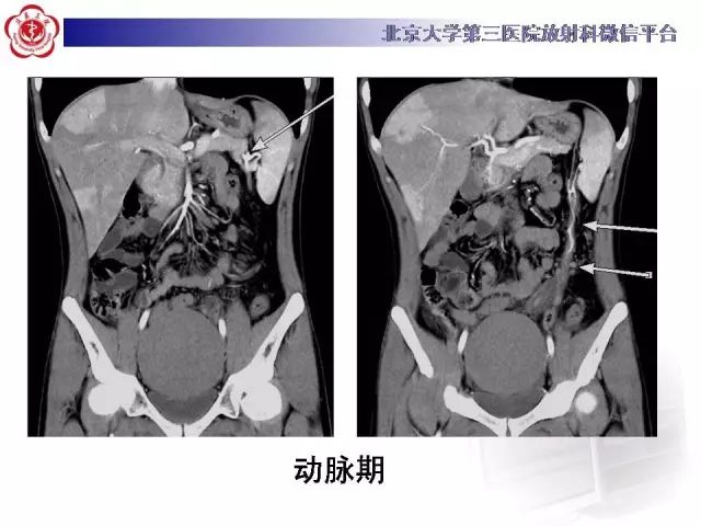 【病例】盆腔副脾蒂扭转1例CT