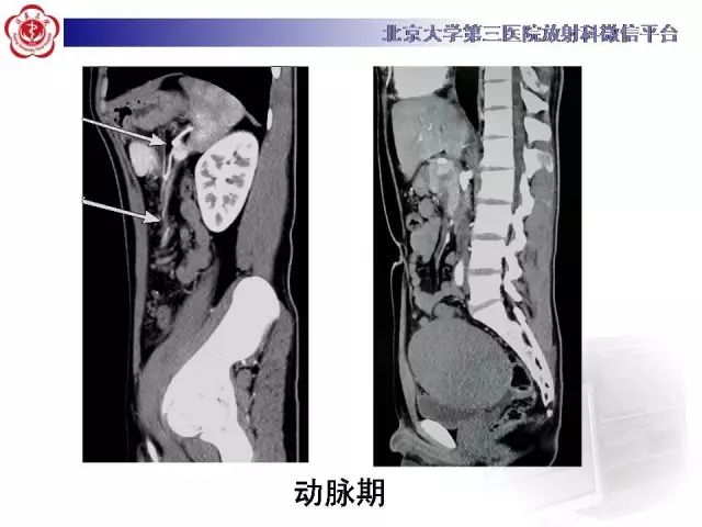 【病例】盆腔副脾蒂扭转1例CT