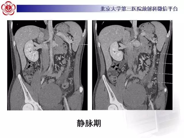 【病例】盆腔副脾蒂扭转1例CT