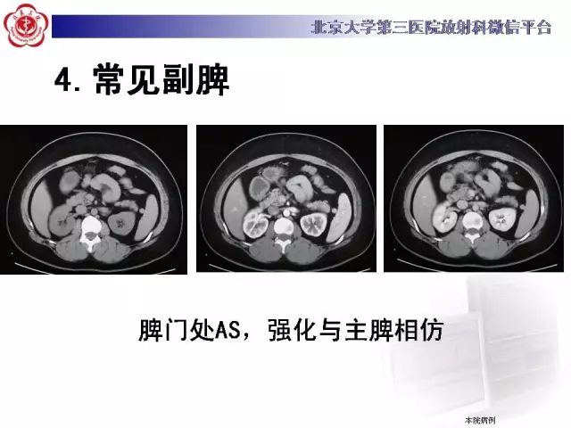 【病例】盆腔副脾蒂扭转1例CT