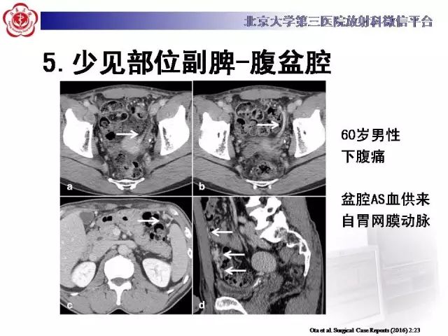 【病例】盆腔副脾蒂扭转1例CT