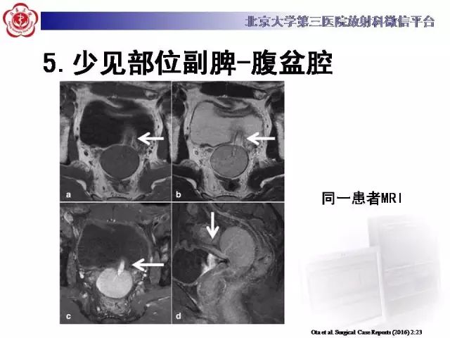 【病例】盆腔副脾蒂扭转1例CT